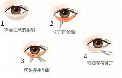 眼袋手術最佳年齡，了解、選擇與準備，眼袋手術的最佳年齡，了解、選擇與準備攻略