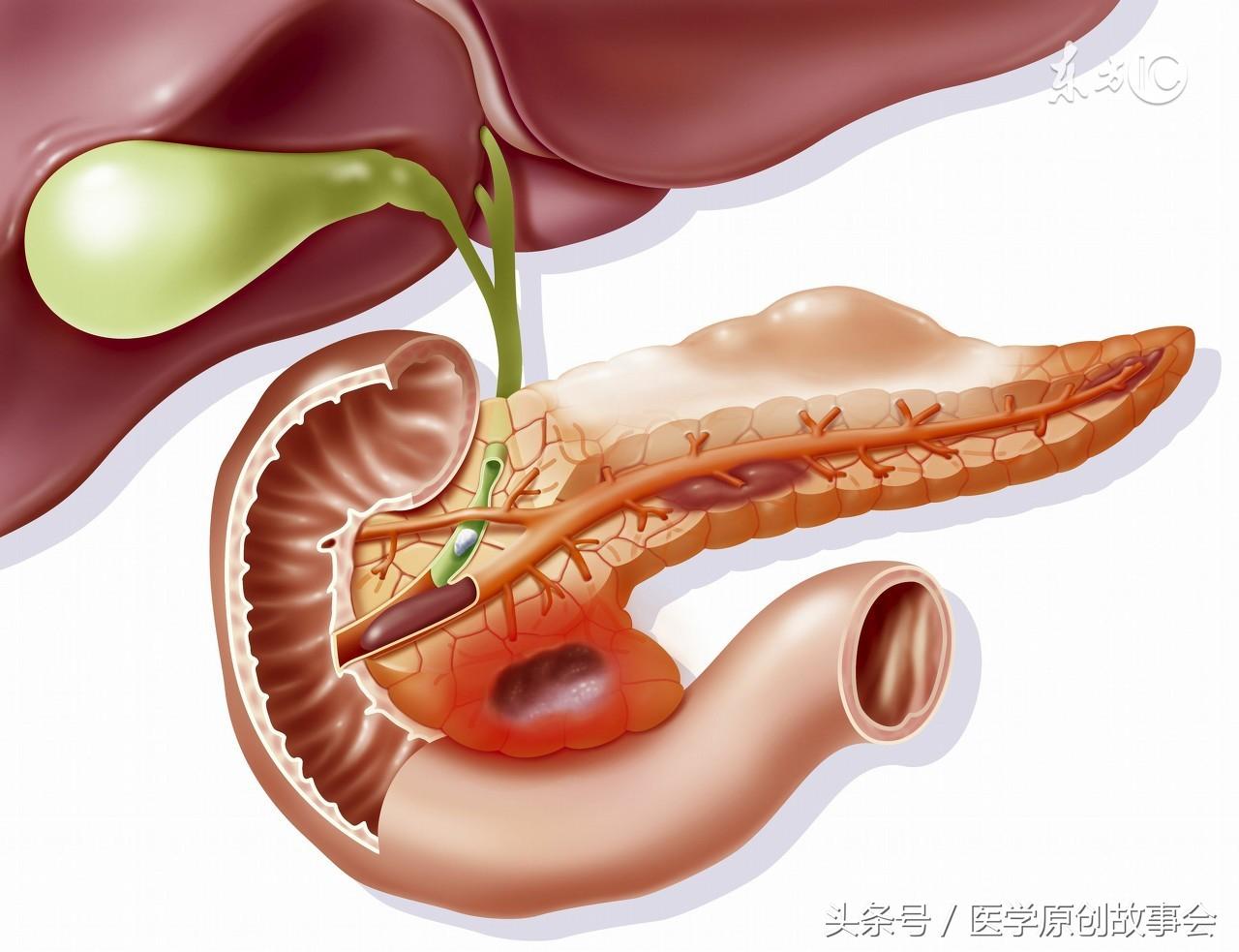 結(jié)石快要掉下來的前兆——預(yù)防與應(yīng)對(duì)的指南，結(jié)石脫落預(yù)警，預(yù)防與應(yīng)對(duì)策略指南