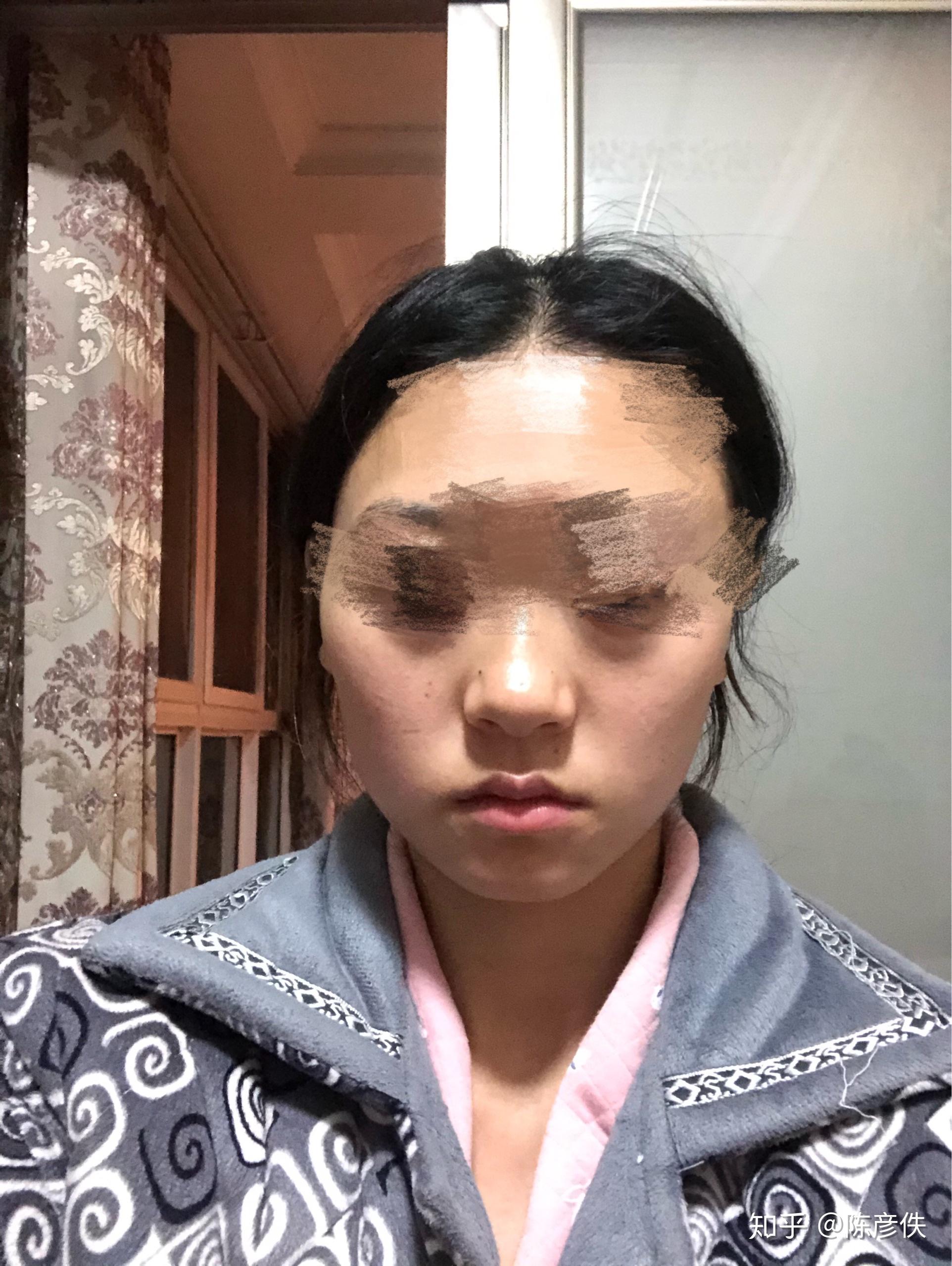 如何糾正臉一邊大一邊小，全面解析與實用建議，全面解析與實用建議，糾正臉一邊大一邊小的有效方法