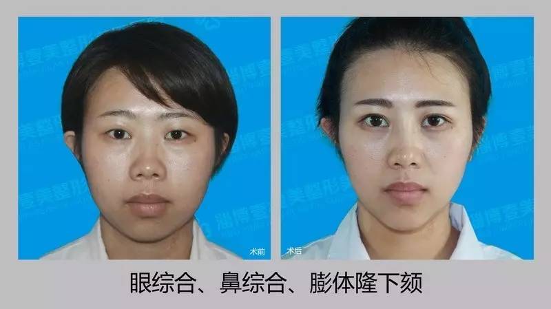 女孩割雙眼皮最佳年齡，了解、選擇與成長(zhǎng)，女孩割雙眼皮的最佳年齡，了解、選擇與成長(zhǎng)的重要性