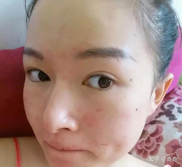 臉上痘痘怎么快速消除——全方位指南，全方位指南，如何快速消除臉部痘痘？