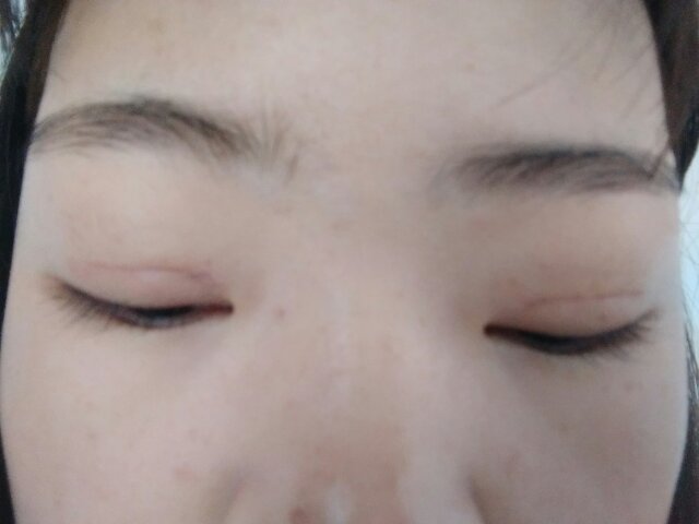 雙眼皮手術(shù)恢復(fù)過(guò)程
