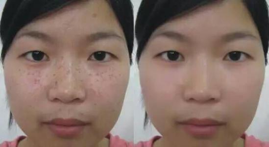臉上長斑怎么樣才能去除——全方位解析祛斑方法，全方位解析，如何有效去除臉部斑點