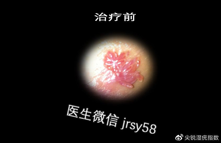 男性濕銳疣初期癥狀詳解，男性尖銳濕疣初期癥狀詳解