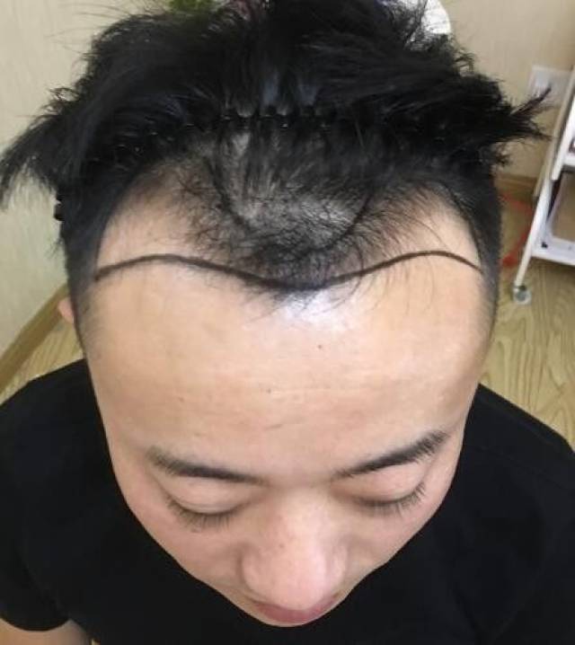 頭頂頭發(fā)稀少怎么補(bǔ)救，多種方法助你重獲濃密秀發(fā)，頭頂頭發(fā)稀少怎么辦？多種方法助你恢復(fù)濃密秀發(fā)