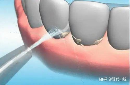 洗牙對(duì)牙齒有傷害嗎？深入了解洗牙與牙齒健康的關(guān)系，洗牙對(duì)牙齒的影響解析，深入了解洗牙與牙齒健康的關(guān)聯(lián)