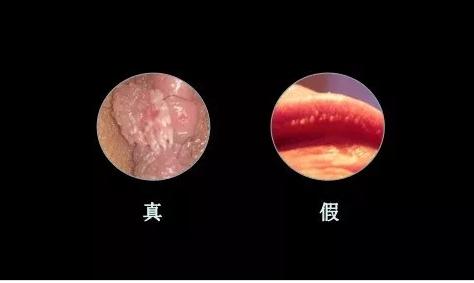 假疣和真疣的區(qū)別，深入了解兩種病癥的不同點，假疣與真疣的差異性解析，深入了解兩種病癥的區(qū)別