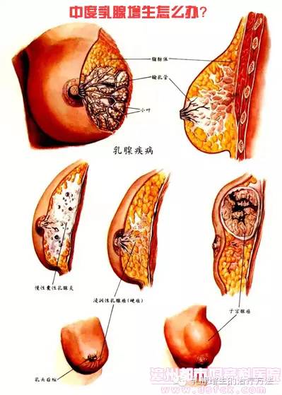 乳腺增生怎么治最好，全面解析最佳治療方法，乳腺增生最佳治療方法全面解析