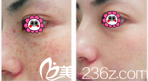 臉部激光祛斑的價格究竟是多少？全面解析費用因素，臉部激光祛斑價格詳解，全面解析費用因素