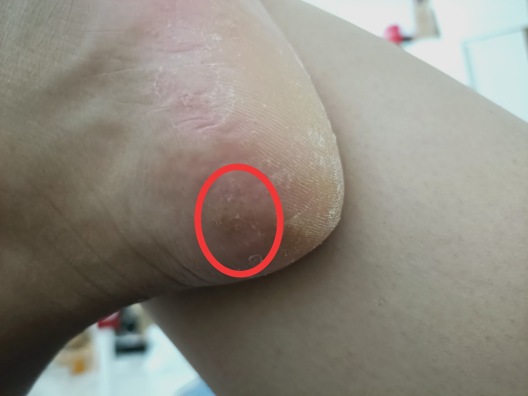 腳底長(zhǎng)了像水泡一樣的東西很癢，是什么原因？SEO解讀與應(yīng)對(duì)建議，腳底水泡狀突起引發(fā)癢感，原因解析與SEO解讀應(yīng)對(duì)之策