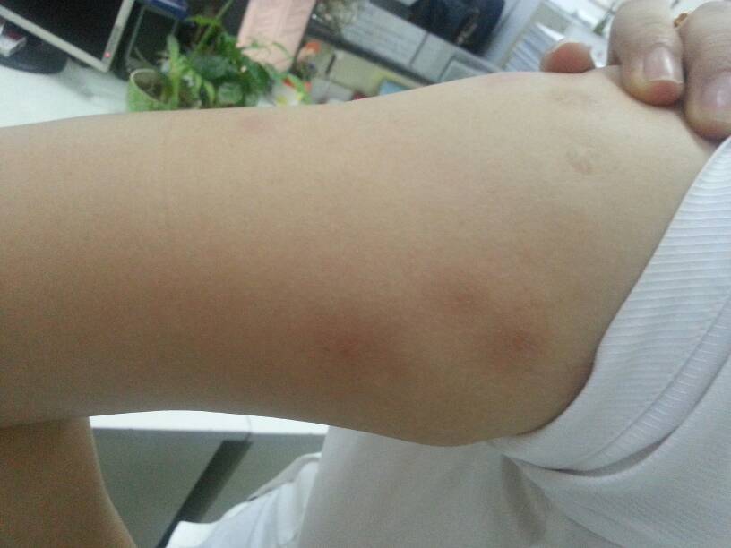 身上無端起包癢，蚊子咬還是其他原因？一文解析真相，身上無端起包癢，原因解析，蚊子咬還是其他因素？