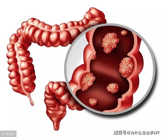 大便干硬堵在肛門(mén)口拉不出來(lái)怎么辦？解決方法與預(yù)防策略，解決大便干硬、排便困難的方法與預(yù)防策略