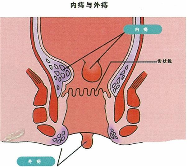 痔瘡手術(shù)費(fèi)用詳解，多少錢左右？，痔瘡手術(shù)費(fèi)用詳解，了解手術(shù)費(fèi)用大概范圍