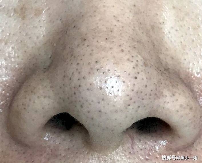 去黑頭的有效方法，有效去黑頭方法大全