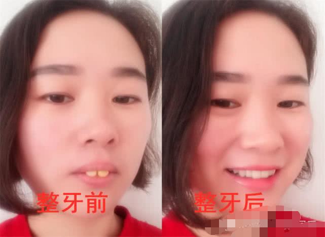 整牙幾年后全部反彈，原因分析與解決方案，整牙多年后反彈現(xiàn)象揭秘，原因分析及解決方案探討