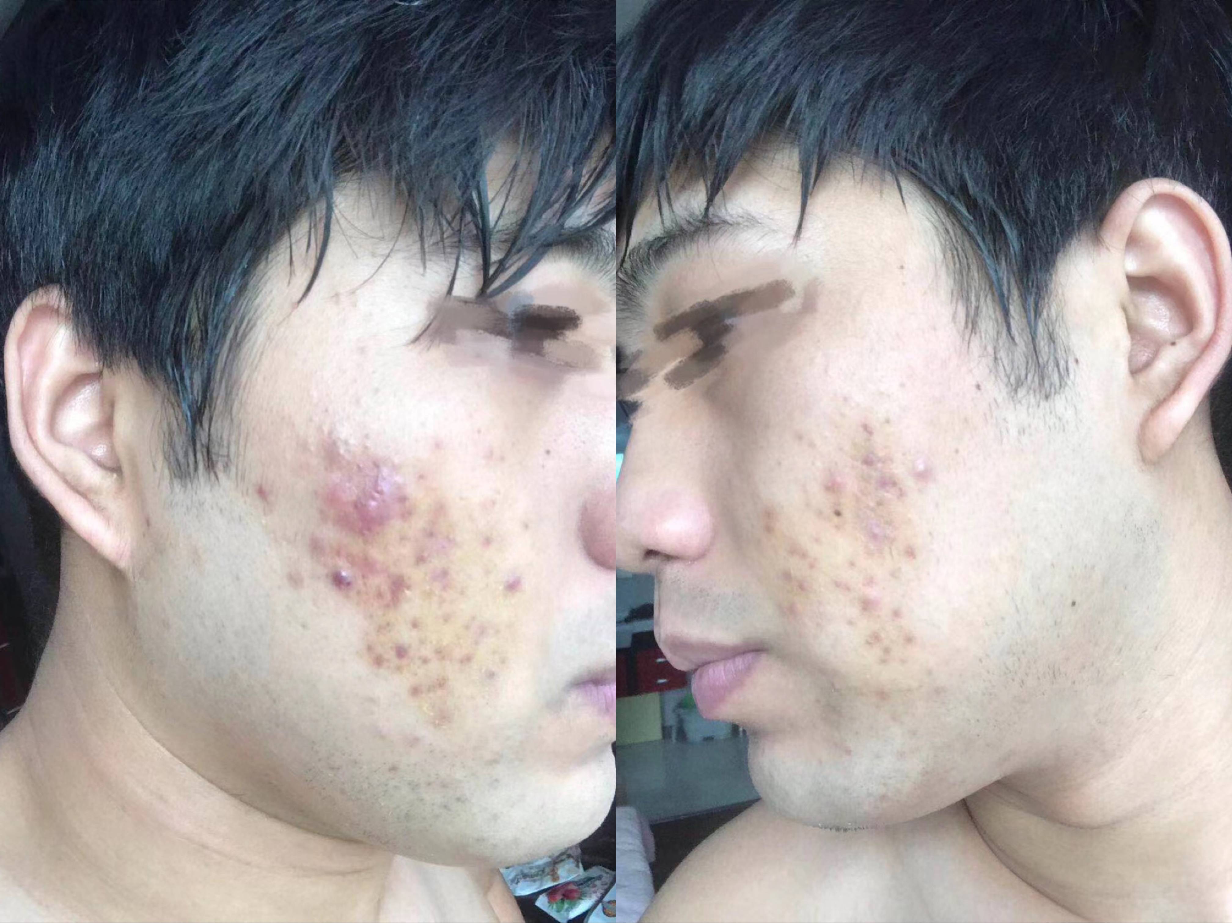 臉上痤瘡老是反反復(fù)復(fù)發(fā)怎么辦？全面解析與應(yīng)對方法，全面解析應(yīng)對臉部反復(fù)痤瘡的方法與策略