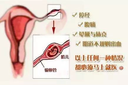 宮外孕的初期癥狀，宮外孕的初期癥狀及識(shí)別