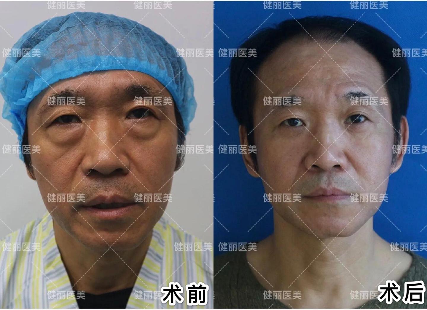 男士大眼袋消除方法，全方位指南，男士大眼袋消除全方位指南，打造魅力雙眼！