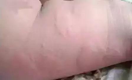 如何判斷自己是否得了蕁麻疹？全面解析蕁麻疹癥狀與診斷方法，如何診斷蕁麻疹？全面解析癥狀與診斷方法