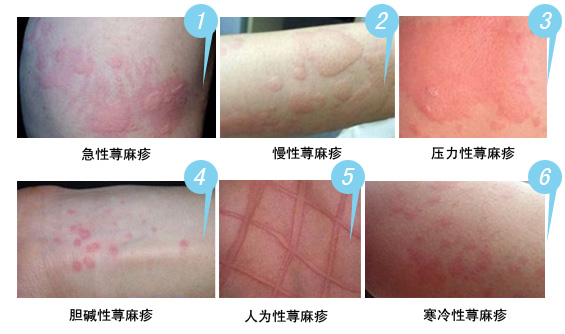 風(fēng)疹和蕁麻疹的區(qū)別，深入了解兩種常見(jiàn)皮膚病的差異，風(fēng)疹與蕁麻疹，深入了解兩種皮膚病的差異