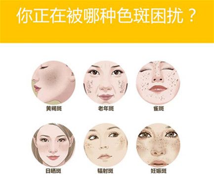 各種斑的區(qū)別圖片，深入了解不同斑點(diǎn)的特征，深入了解不同斑點(diǎn)的特征，各種斑的區(qū)別圖片解析