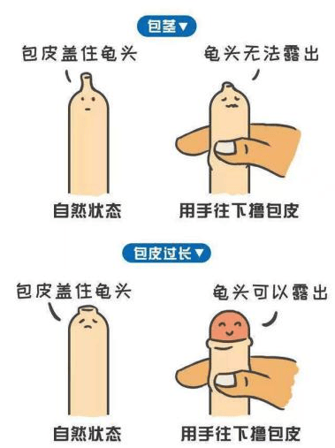 割了包皮多久恢復(fù)正?！媪私饣謴?fù)時(shí)間與注意事項(xiàng)，包皮手術(shù)后恢復(fù)時(shí)間與注意事項(xiàng)全解析，多久恢復(fù)正常？