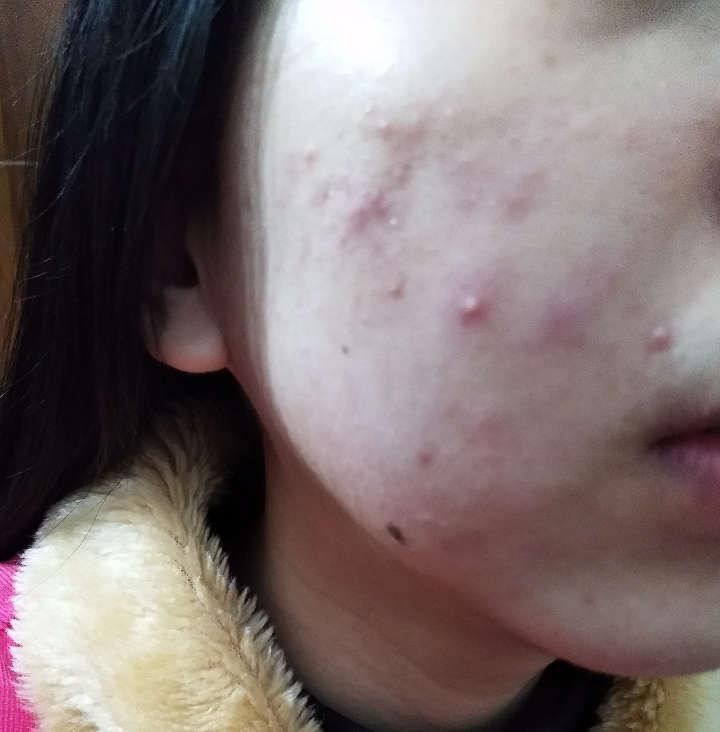 臉上痤瘡怎么治，全方位解決方案，全方位解決臉上痤瘡問題，有效治療方案全解析