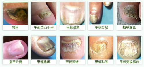 早期灰指甲圖片解析與識別，早期灰指甲圖片解析與識別指南