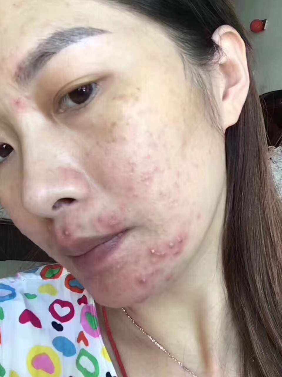 臉上痤瘡最佳的自愈方法，臉上痤瘡最佳自愈方法攻略
