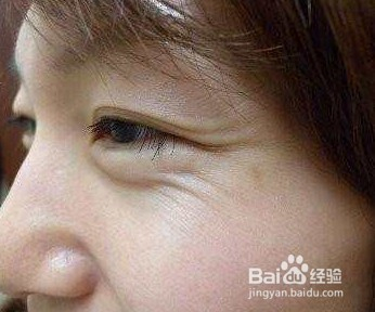 醫(yī)美除皺最佳方法解析，醫(yī)美除皺最佳方法深度解析