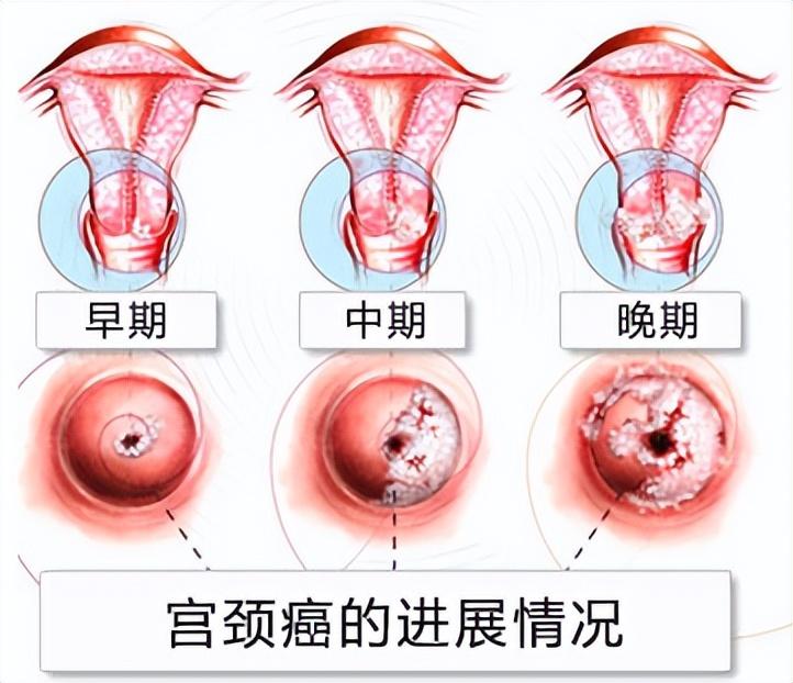 TCT與HPV檢測的區(qū)別，深入了解兩種篩查方法的差異，TCT與HPV檢測的區(qū)別，全面解析兩種篩查方法的差異