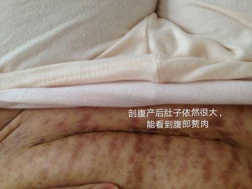 剖腹產(chǎn)后惡露多久排完，全面解析與護(hù)理建議，剖腹產(chǎn)后惡露排盡全程解析及護(hù)理建議