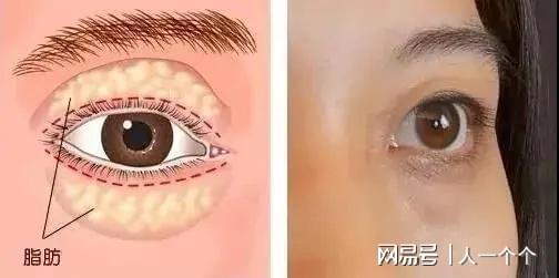 祛眼袋手術(shù)效果可以維持多久，全面解析與深度理解，祛眼袋手術(shù)效果持久性解析，全面深度理解維持時(shí)間因素